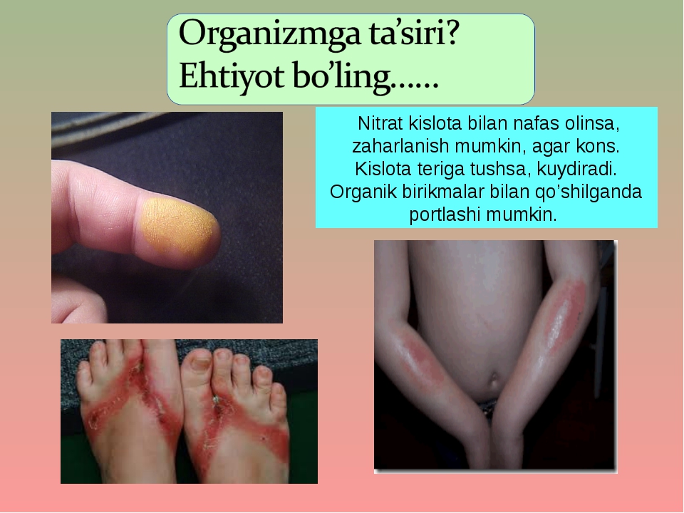 Nitrat kislota bilan nafas olinsa, zaharlanish mumkin, agar kons. Kislota te... Nitrat kislota bilan nafas olinsa, zaharlanish mumkin, agar kons. Kislota te...